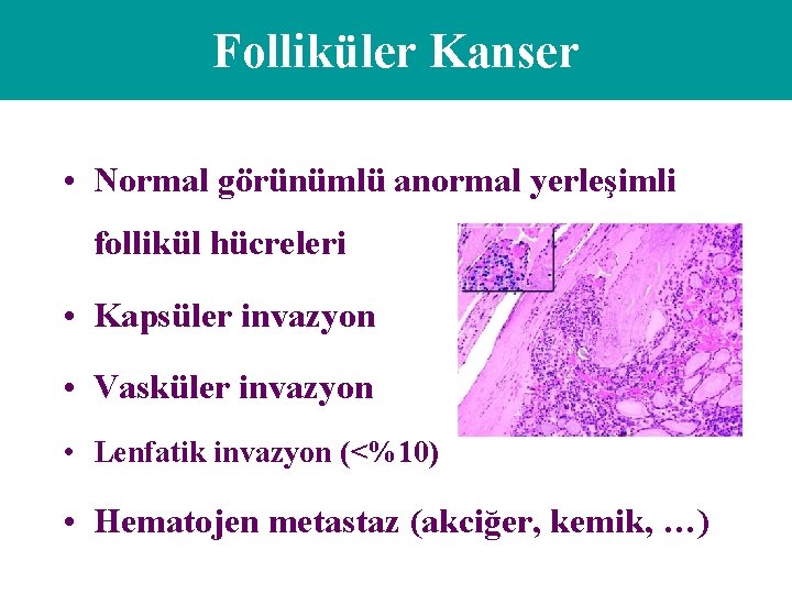 Folliküler Kanser • Normal görünümlü anormal yerleşimli follikül hücreleri • Kapsüler invazyon • Vasküler