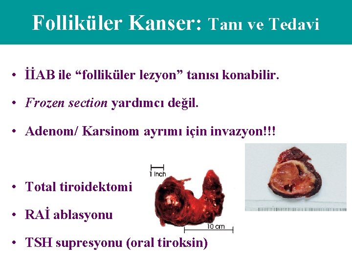 Folliküler Kanser: Tanı ve Tedavi • İİAB ile “folliküler lezyon” tanısı konabilir. • Frozen