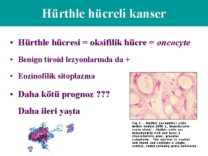 Hürthle hücreli kanser • Hürthle hücresi = oksifilik hücre = oncocyte • Benign tiroid