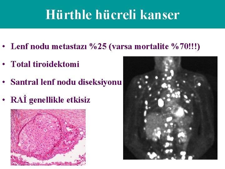 Hürthle hücreli kanser • Lenf nodu metastazı %25 (varsa mortalite %70!!!) • Total tiroidektomi