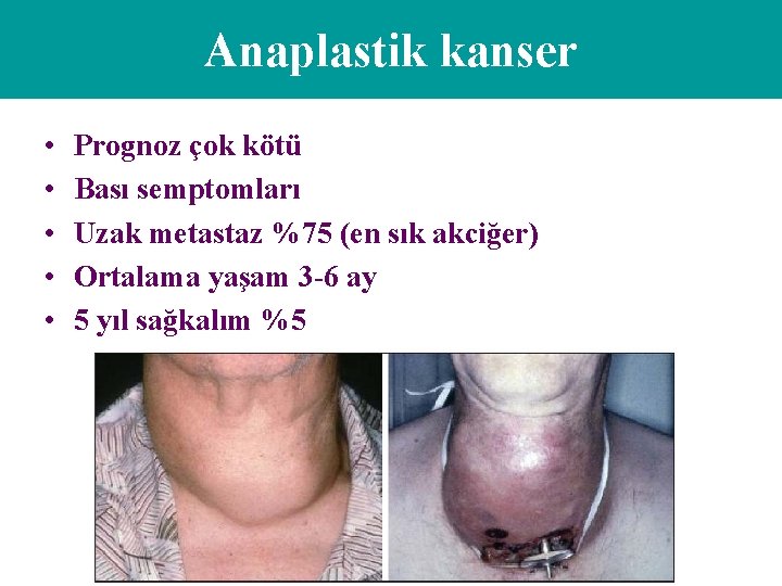 Anaplastik kanser • • • Prognoz çok kötü Bası semptomları Uzak metastaz %75 (en