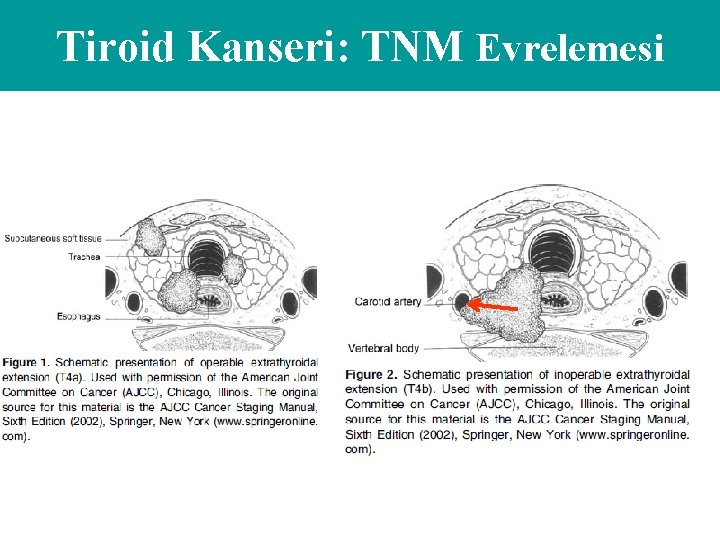 Tiroid Kanseri: TNM Evrelemesi 