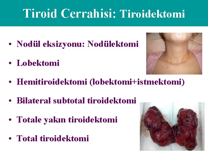 Tiroid Cerrahisi: Tiroidektomi • Nodül eksizyonu: Nodülektomi • Lobektomi • Hemitiroidektomi (lobektomi+istmektomi) • Bilateral