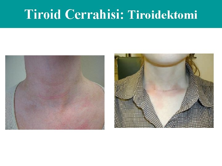 Tiroid Cerrahisi: Tiroidektomi 