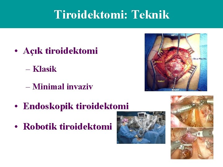 Tiroidektomi: Teknik • Açık tiroidektomi – Klasik – Minimal invaziv • Endoskopik tiroidektomi •