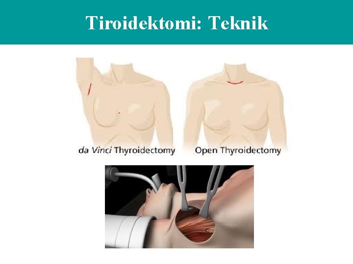 Tiroidektomi: Teknik 