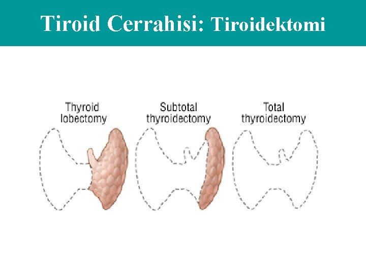 Tiroid Cerrahisi: Tiroidektomi 