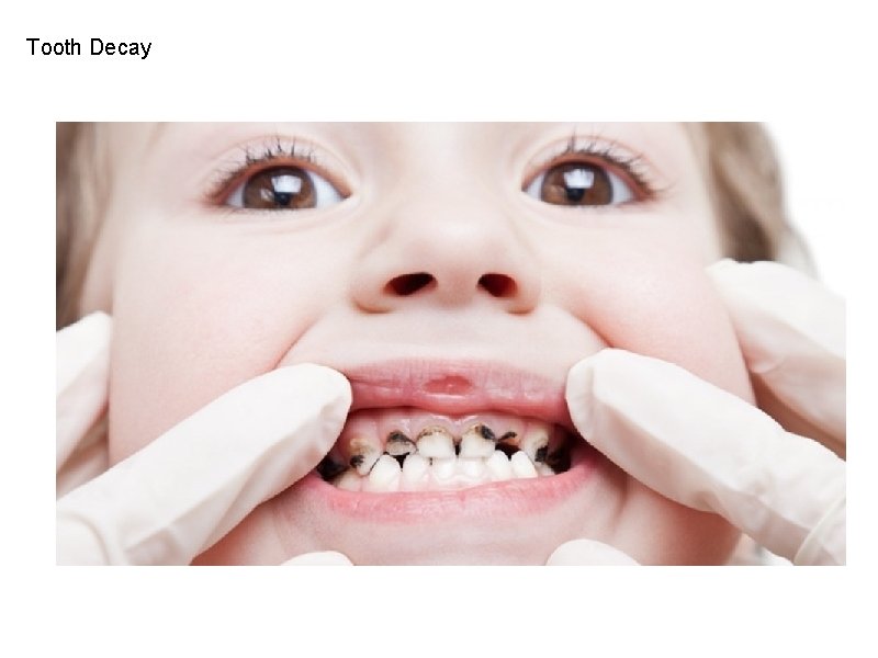 Tooth Decay 