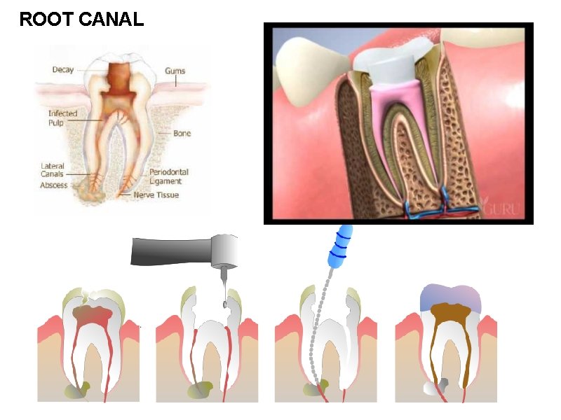 ROOT CANAL 