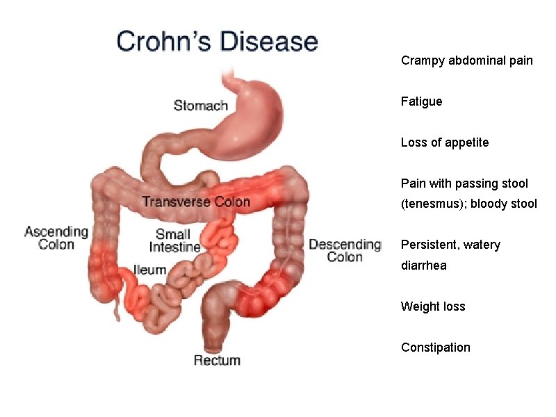 Crampy abdominal pain Fatigue Loss of appetite Pain with passing stool (tenesmus); bloody stool