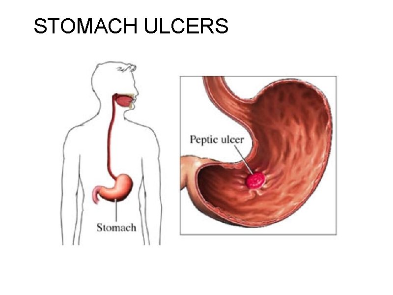 STOMACH ULCERS 
