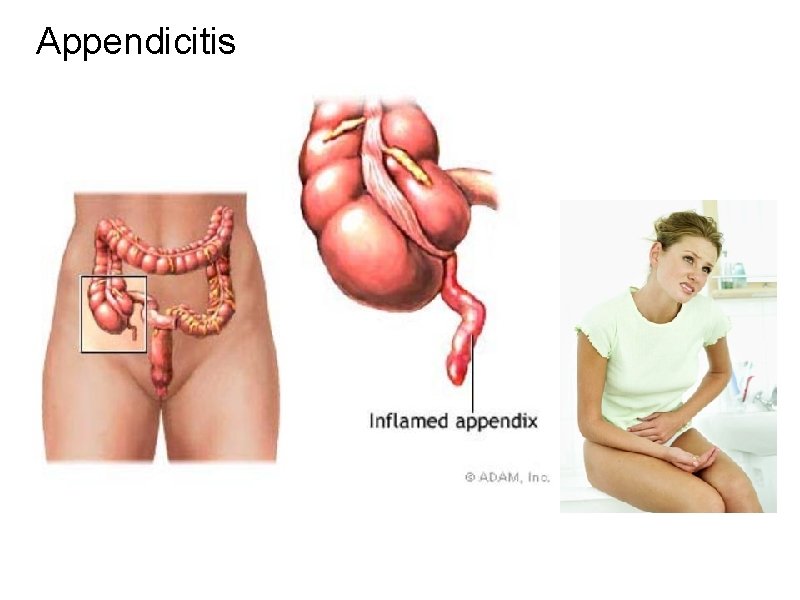 Appendicitis 