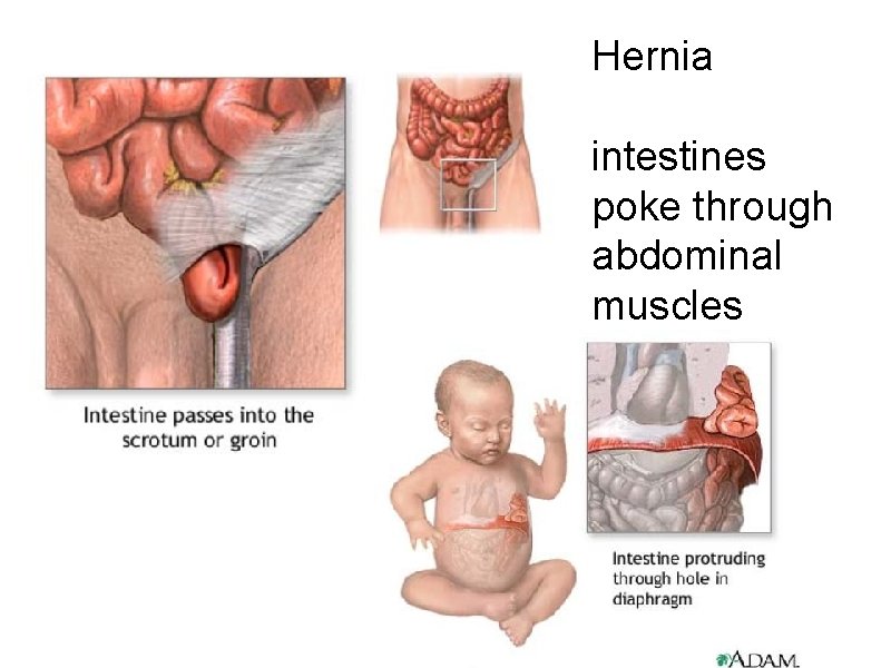 Hernia intestines poke through abdominal muscles 