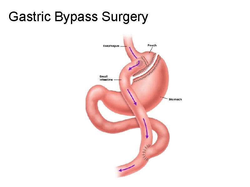 Gastric Bypass Surgery 