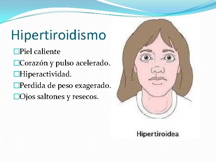 Hipertiroidismo �Piel caliente �Corazón y pulso acelerado. �Hiperactividad. �Perdida de peso exagerado. �Ojos saltones