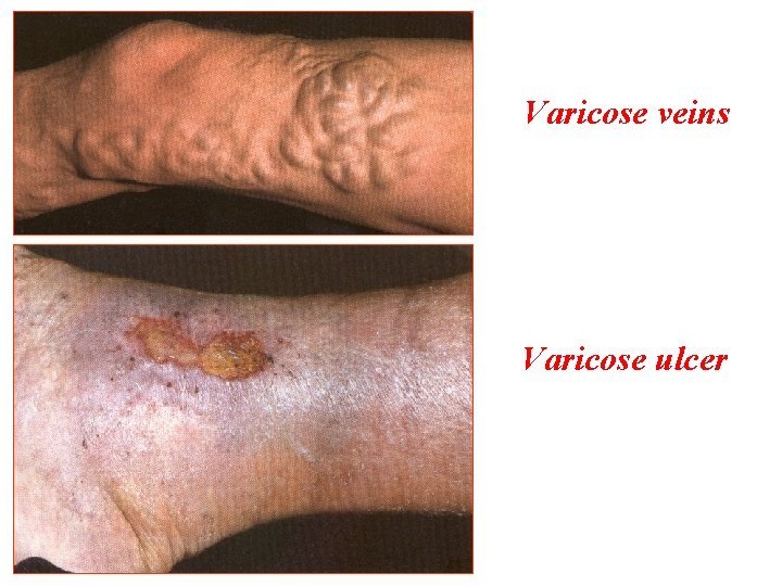 Varicose veins Varicose ulcer 