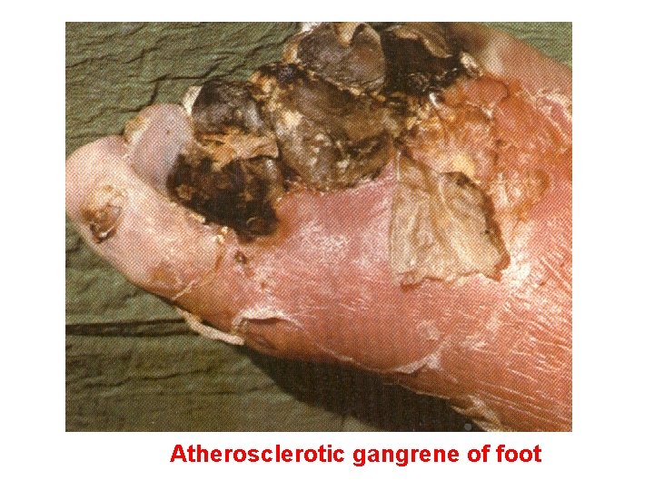 Atherosclerotic gangrene of foot 