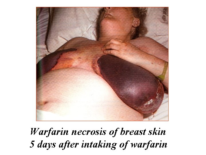 Warfarin necrosis of breast skin 5 days after intaking of warfarin 