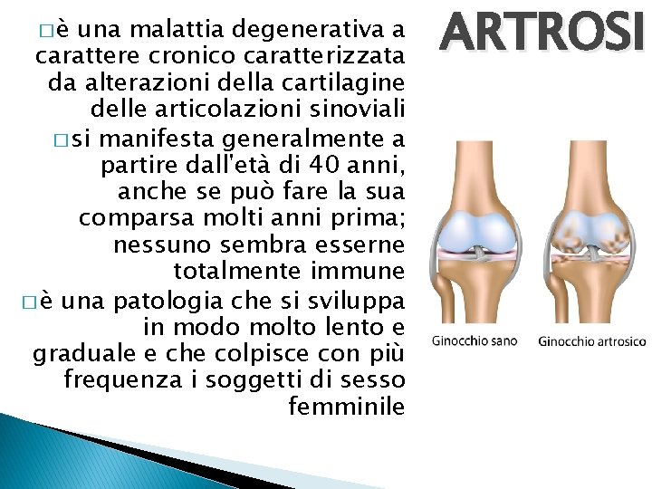 �è una malattia degenerativa a carattere cronico caratterizzata da alterazioni della cartilagine delle articolazioni
