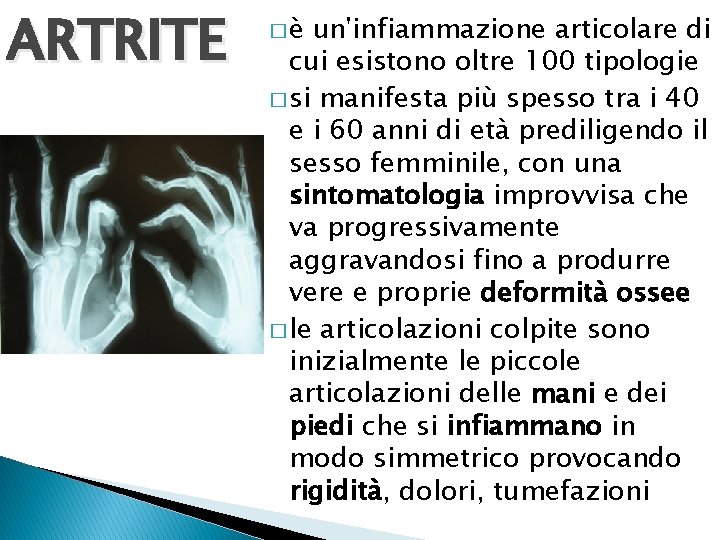 ARTRITE �è un'infiammazione articolare di cui esistono oltre 100 tipologie � si manifesta più