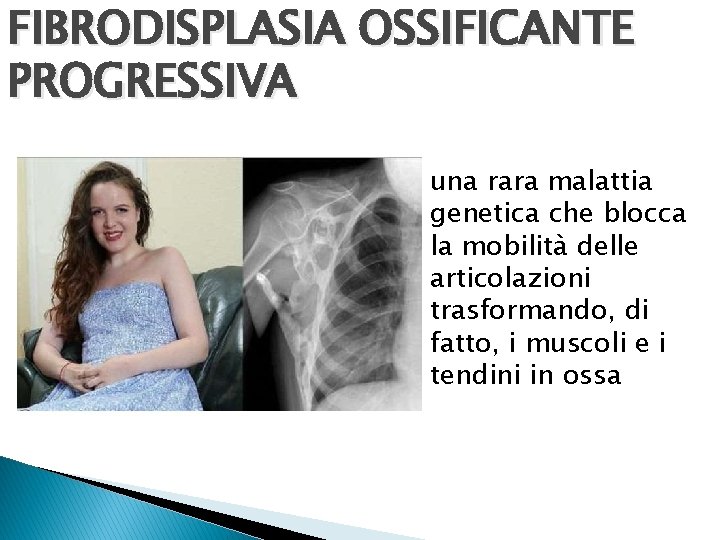 FIBRODISPLASIA OSSIFICANTE PROGRESSIVA una rara malattia genetica che blocca la mobilità delle articolazioni trasformando,