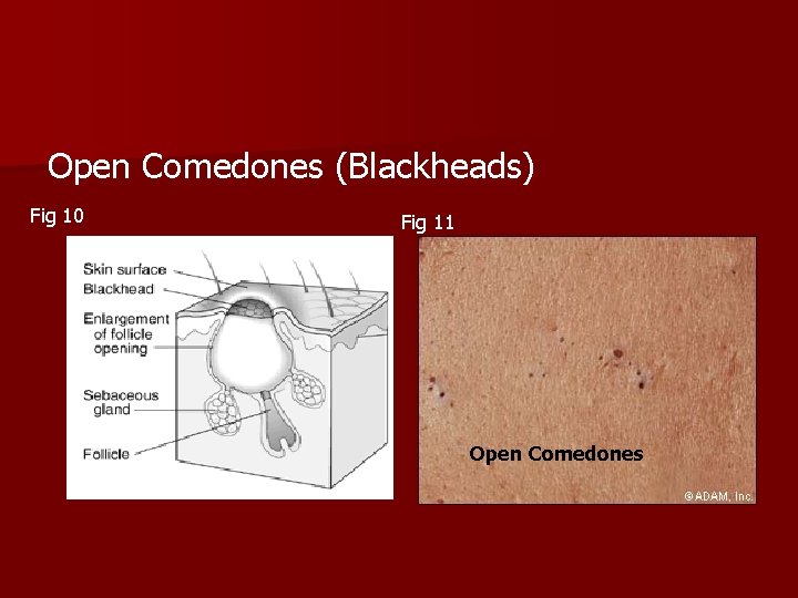 Open Comedones (Blackheads) Fig 10 Fig 11 Open Comedones 