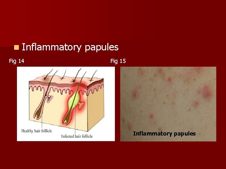 n Inflammatory papules Fig 14 Fig 15 Inflammatory papules 