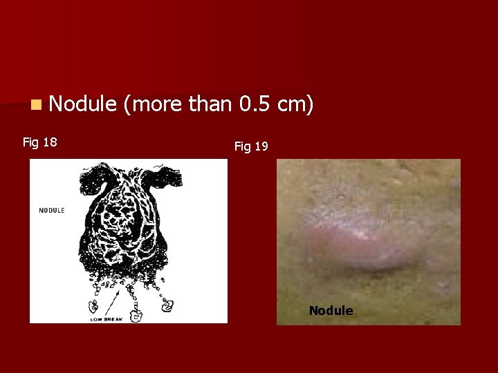 n Nodule (more than 0. 5 cm) Fig 18 Fig 19 Nodule 