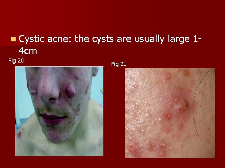 n Cystic acne: the cysts are usually large 1 - 4 cm Fig 20