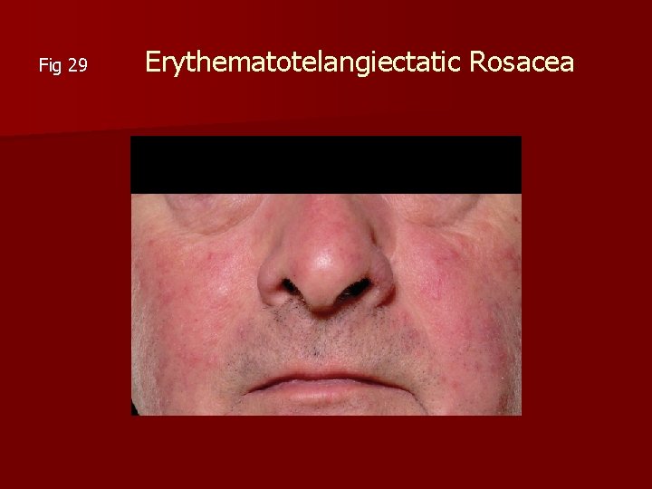 Erythematotelangiectatic Rosacea Fig 29 
