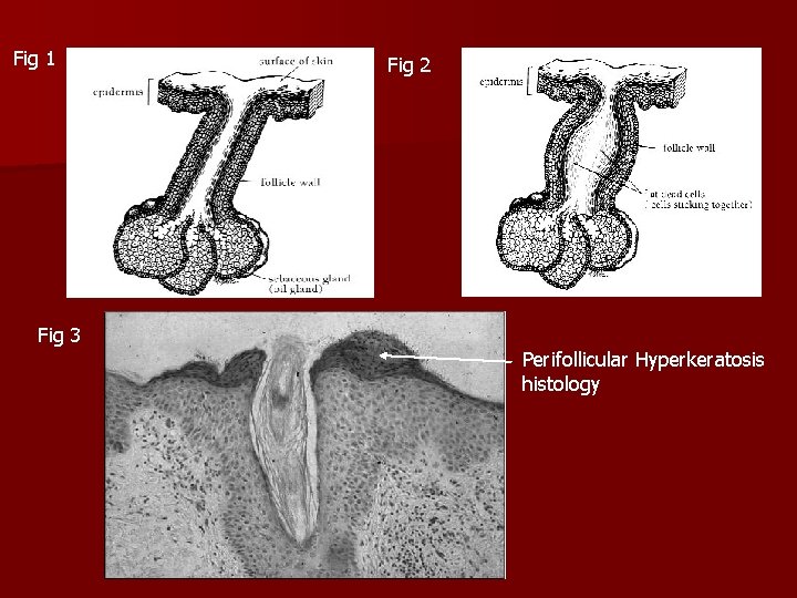 Fig 1 Fig 2 Fig 3 Perifollicular Hyperkeratosis histology 