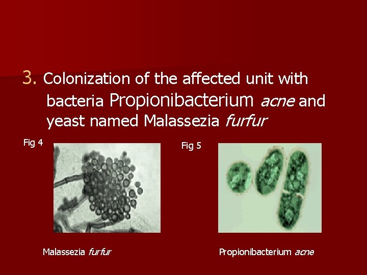3. Colonization of the affected unit with bacteria Propionibacterium acne and yeast named Malassezia