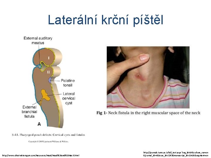 Laterální krční píštěl http: //www. ultratwistersgym. com/Resources/Head%20 and%20 Neck. html http: //journals. tums. ac.