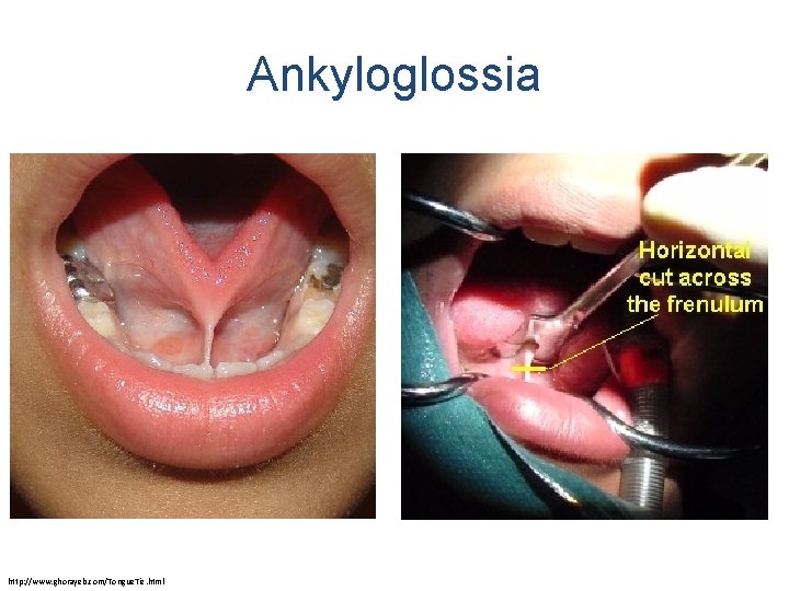 Ankyloglossia http: //www. ghorayeb. com/Tongue. Tie. html 