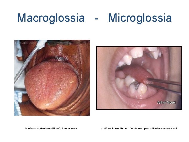 Macroglossia - Microglossia http: //www. consultantlive. com/display/article/10162/43839 http: //dentallecnotes. blogspot. cz/2011/08/developmental-disturbances-of-tongue. html 