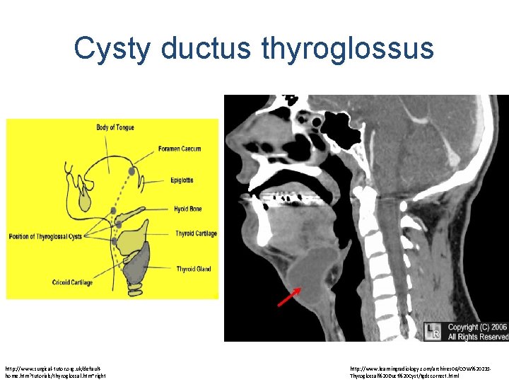Cysty ductus thyroglossus http: //www. surgical-tutor. org. uk/defaulthome. htm? tutorials/thyroglossal. htm~right http: //www. learningradiology.