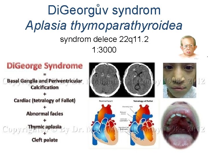 Di. Georgův syndrom Aplasia thymoparathyroidea syndrom delece 22 q 11. 2 1: 3000 