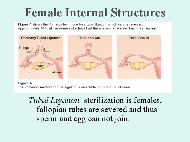 Female Internal Structures Tubal Ligation- sterilization is females, fallopian tubes are severed and thus