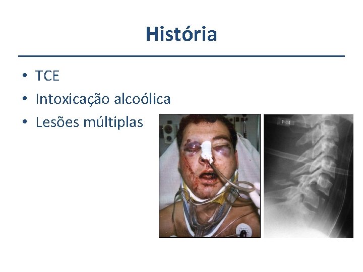 História • TCE • Intoxicação alcoólica • Lesões múltiplas 