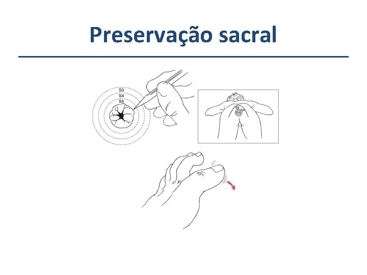 Preservação sacral 