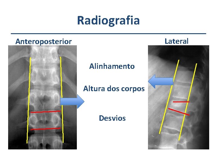 Radiografia Lateral Anteroposterior Alinhamento Altura dos corpos Desvios 