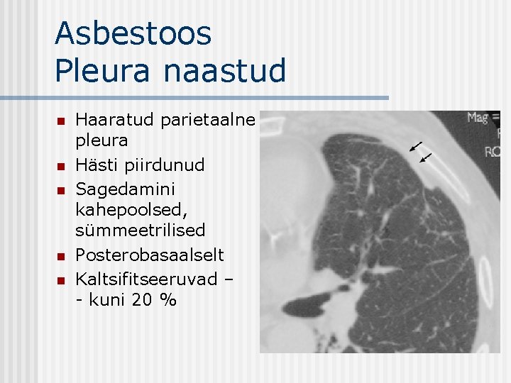 Asbestoos Pleura naastud n n n Haaratud parietaalne pleura Hästi piirdunud Sagedamini kahepoolsed, sümmeetrilised