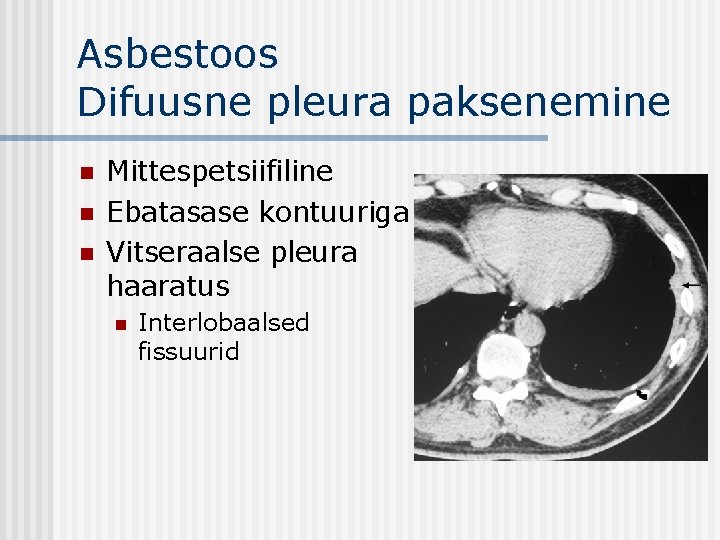 Asbestoos Difuusne pleura paksenemine n n n Mittespetsiifiline Ebatasase kontuuriga Vitseraalse pleura haaratus n