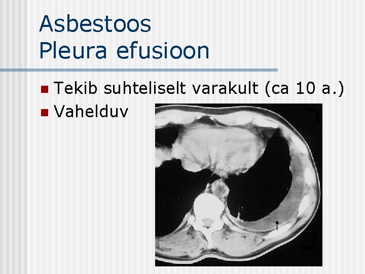 Asbestoos Pleura efusioon Tekib suhteliselt varakult (ca 10 a. ) n Vahelduv n 