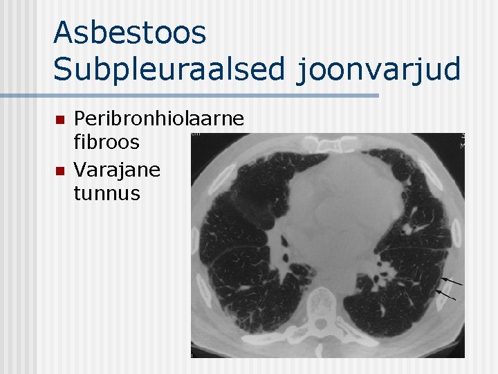 Asbestoos Subpleuraalsed joonvarjud n n Peribronhiolaarne fibroos Varajane tunnus 