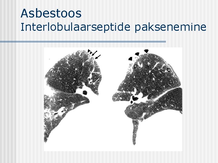 Asbestoos Interlobulaarseptide paksenemine 
