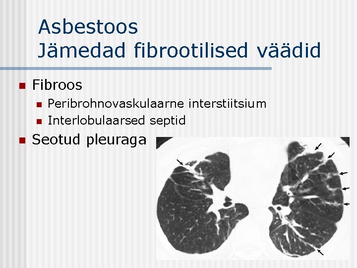 Asbestoos Jämedad fibrootilised väädid n Fibroos n n n Peribrohnovaskulaarne interstiitsium Interlobulaarsed septid Seotud