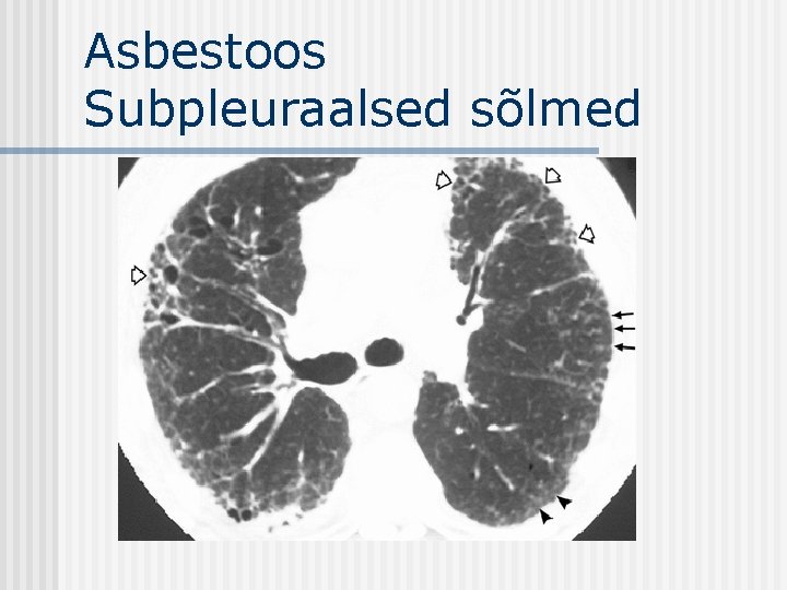 Asbestoos Subpleuraalsed sõlmed 