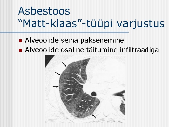 Asbestoos “Matt-klaas”-tüüpi varjustus n n Alveoolide seina paksenemine Alveoolide osaline täitumine infiltraadiga 