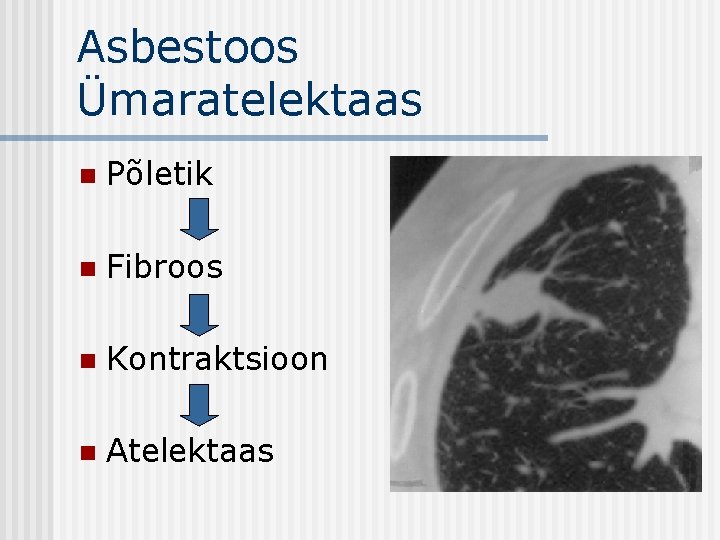 Asbestoos Ümaratelektaas n Põletik n Fibroos n Kontraktsioon n Atelektaas 